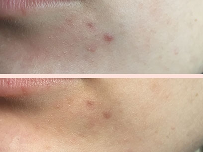 CMD Naturkosmetik пети и седми ден след чаено дърво