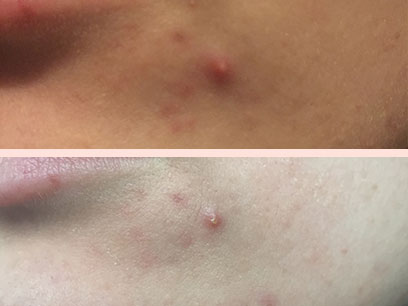 CMD Naturkosmetik първи и трети ден след чаено дърво