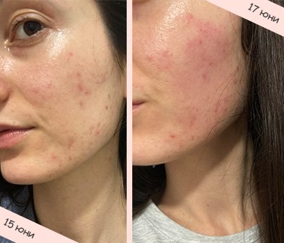 La Roche-Posay Effaclar серум против акне