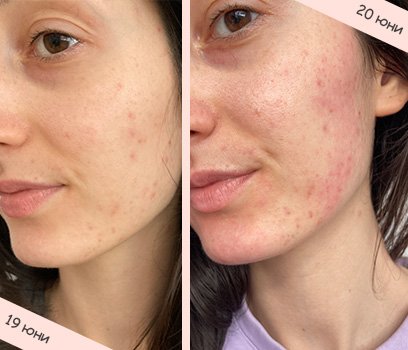 La Roche-Posay Effaclar серум с киселини