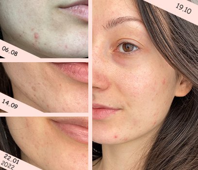 Effaclar серум за кожа склонна към акне в зряла възраст